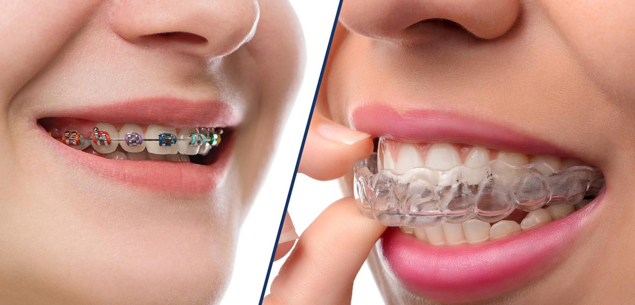 Invisalign London
